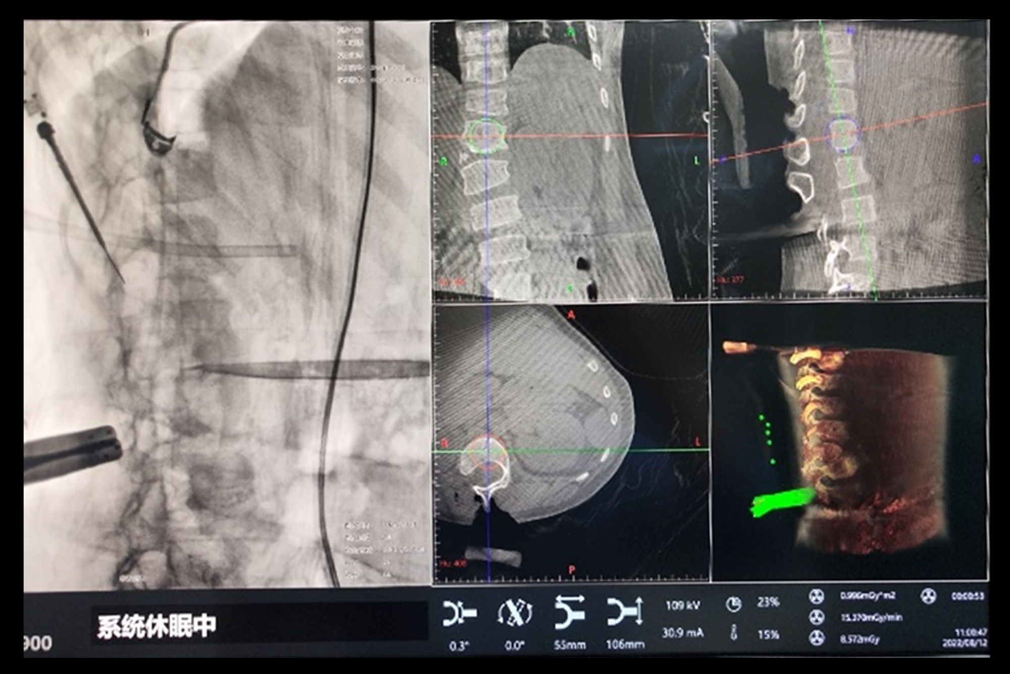 一影临床案例分享（十）| 三维C形臂在脊柱椎弓根钉棒系统内固定术中的应用