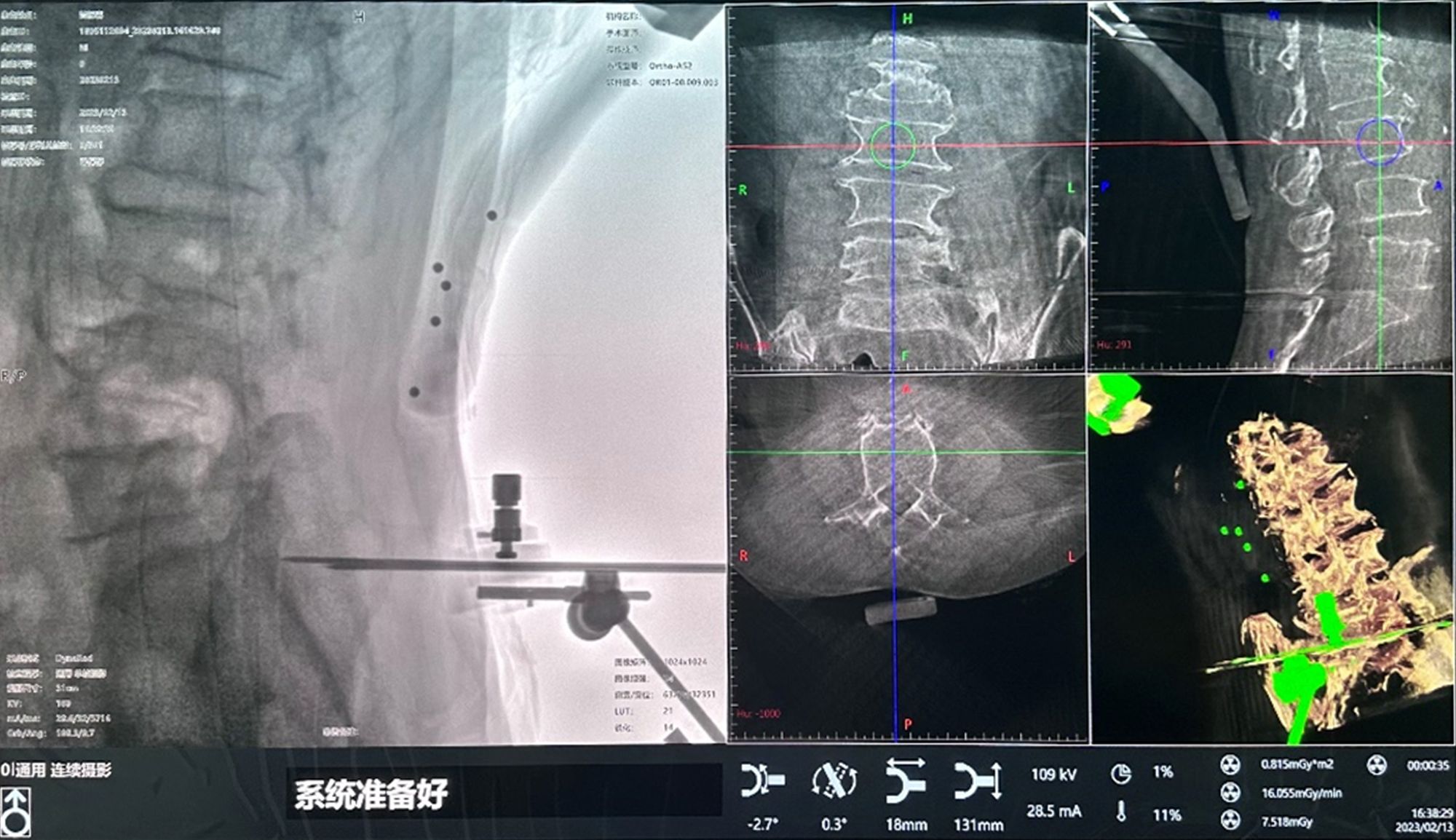 案例分享(十一) | 三维C形臂在脊柱椎体滑脱椎弓根螺钉内固定复位中的应用